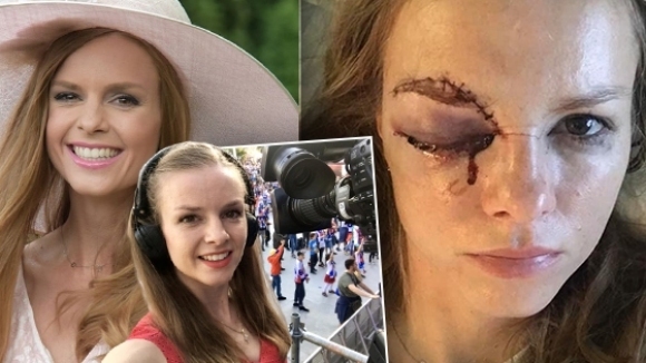 Словашка журналистка в болница след удар с хокейна шайба